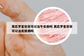 莫匹罗星软膏可以治牛皮癣吗 莫匹罗星软膏可以治皮肤病吗