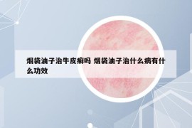 烟袋油子治牛皮癣吗 烟袋油子治什么病有什么功效