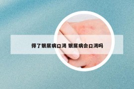 得了银屑病口渴 银屑病会口渴吗