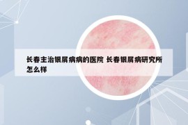 长春主治银屑病病的医院 长春银屑病研究所怎么样