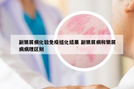 副银屑病化验免疫组化结果 副银屑病和银屑病病理区别