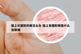 腿上长圆形的癣怎么办 腿上有圆形癣是什么皮肤病