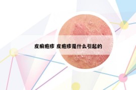 皮癣疱疹 皮疱疹是什么引起的