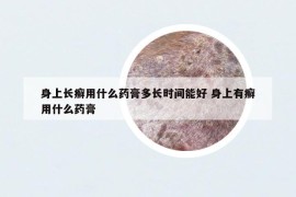 身上长癣用什么药膏多长时间能好 身上有癣用什么药膏