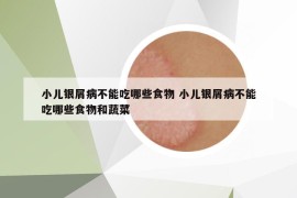 小儿银屑病不能吃哪些食物 小儿银屑病不能吃哪些食物和蔬菜