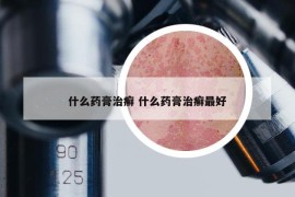 什么药膏治癣 什么药膏治癣最好