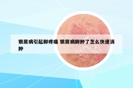 银屑病引起脚疼痛 银屑病脚肿了怎么快速消肿