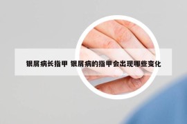 银屑病长指甲 银屑病的指甲会出现哪些变化