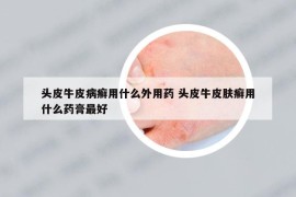 头皮牛皮病癣用什么外用药 头皮牛皮肤癣用什么药膏最好