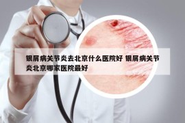 银屑病关节炎去北京什么医院好 银屑病关节炎北京哪家医院最好