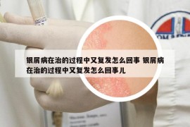 银屑病在治的过程中又复发怎么回事 银屑病在治的过程中又复发怎么回事儿