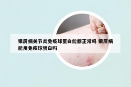 银屑病关节炎免疫球蛋白能都正常吗 银屑病能用免疫球蛋白吗