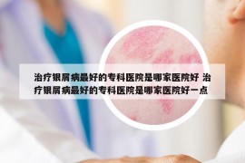 治疗银屑病最好的专科医院是哪家医院好 治疗银屑病最好的专科医院是哪家医院好一点