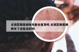 点滴型银屑病每年都会复发吗 点滴型银屑病两年了还能治好吗