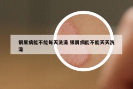 银屑病能不能每天洗澡 银屑病能不能天天洗澡