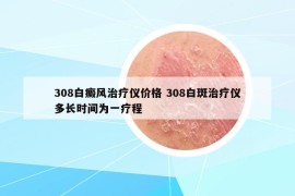 308白癜风治疗仪价格 308白斑治疗仪多长时间为一疗程