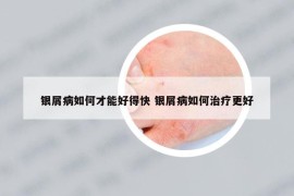 银屑病如何才能好得快 银屑病如何治疗更好