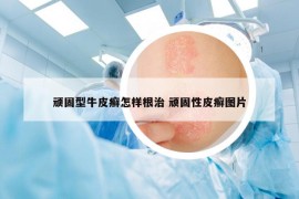 顽固型牛皮癣怎样根治 顽固性皮癣图片