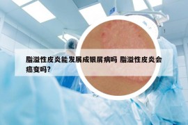 脂溢性皮炎能发展成银屑病吗 脂溢性皮炎会癌变吗?