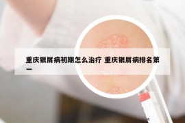 重庆银屑病初期怎么治疗 重庆银屑病排名第一