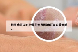 银屑病可以吃小黄花鱼 银屑病可以吃黄鳝吗?