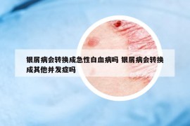 银屑病会转换成急性白血病吗 银屑病会转换成其他并发症吗