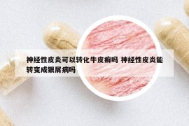 神经性皮炎可以转化牛皮癣吗 神经性皮炎能转变成银屑病吗