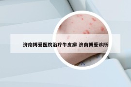 济南博爱医院治疗牛皮癣 济南博爱诊所