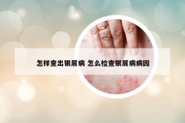 怎样查出银屑病 怎么检查银屑病病因