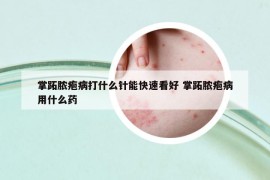 掌跖脓疱病打什么针能快速看好 掌跖脓疱病用什么药