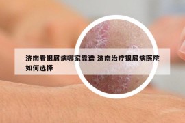 济南看银屑病哪家靠谱 济南治疗银屑病医院如何选择