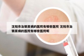 沈阳市治银屑病的医院有哪些医院 沈阳市治银屑病的医院有哪些医院呢