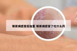 银屑病感冒后加重 银屑病感冒了吃什么药