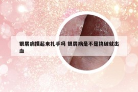 银屑病摸起来扎手吗 银屑病是不是挠破就出血