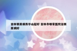 吉林银屑病羡华山超好 吉林市哪家医院治银屑病好