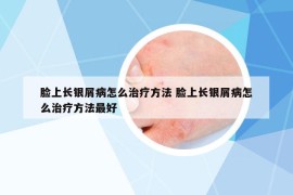 脸上长银屑病怎么治疗方法 脸上长银屑病怎么治疗方法最好