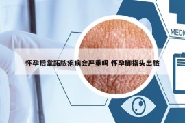 怀孕后掌跖脓疱病会严重吗 怀孕脚指头出脓