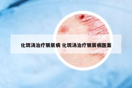 化斑汤治疗银屑病 化斑汤治疗银屑病医案