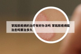 掌跖脓疱病的治疗有好办法吗 掌跖脓疱病能治愈吗要治多久