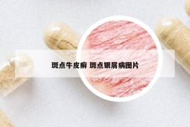 斑点牛皮癣 斑点银屑病图片