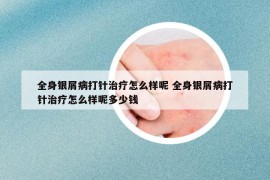 全身银屑病打针治疗怎么样呢 全身银屑病打针治疗怎么样呢多少钱