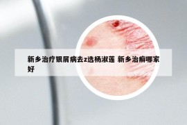 新乡治疗银屑病去z选杨淑莲 新乡治癣哪家好