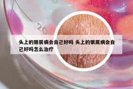 头上的银屑病会自己好吗 头上的银屑病会自己好吗怎么治疗