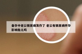 备孕中老公银屑病发作了 老公有银屑病怀孕影响胎儿吗