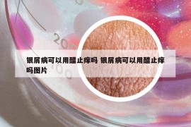 银屑病可以用醋止痒吗 银屑病可以用醋止痒吗图片