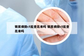 银屑病做ct能查出来吗 银屑病做ct能查出来吗