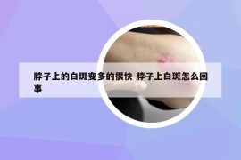 脖子上的白斑变多的很快 脖子上白斑怎么回事