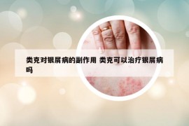 类克对银屑病的副作用 类克可以治疗银屑病吗