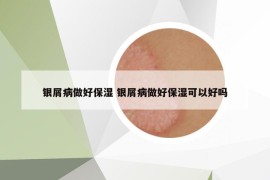 银屑病做好保湿 银屑病做好保湿可以好吗