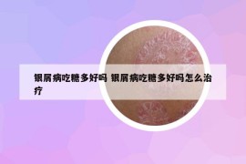 银屑病吃糖多好吗 银屑病吃糖多好吗怎么治疗